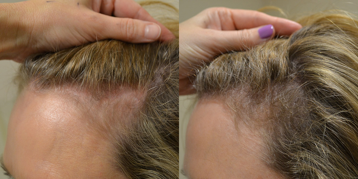 hair loss treatment new research