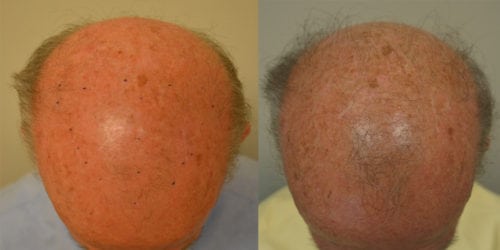 Before and 4 months after 3 sessions of PRP with ACell