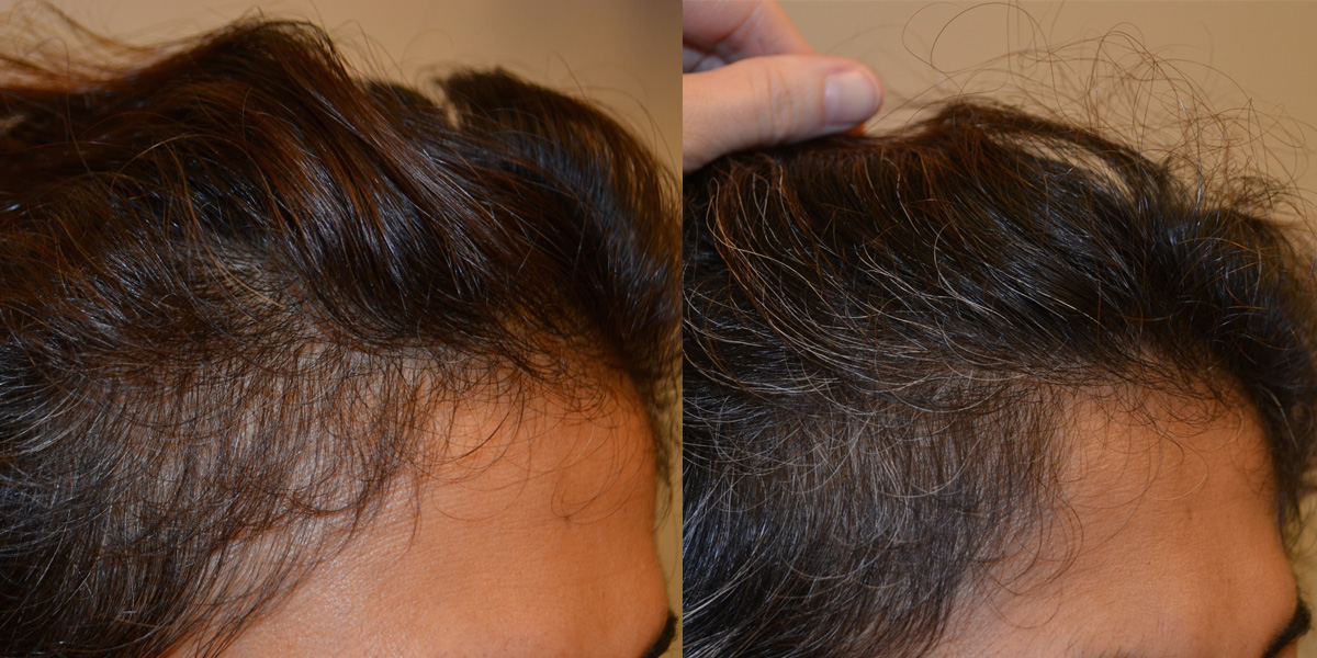 Platelet Rich Plasma (PRP) Before & After Photos Hair Restoration of