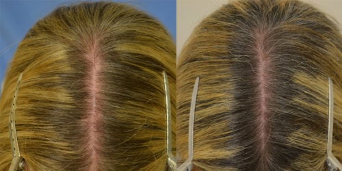 Before and 2 months after 3 sessions of PRP- patient had complete cessation of hair shedding