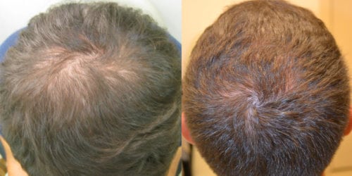 Before and 24 months after initiating treatment with Propecia.
