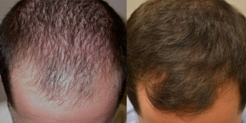 Before and 48 months after initiating treatment with Propecia.