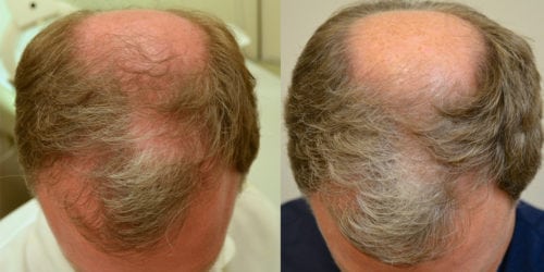Before and 26 months after initiating treatment with Propecia.