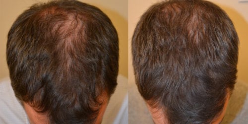 Before and 18 months after initiating treatment with Propecia.