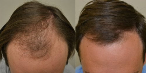 Before and 6 months after initiating treatment with Propecia.