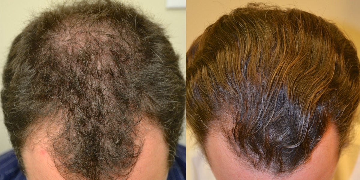 Propecia for Hair Loss - Dr Rogers, New Orleans, LA