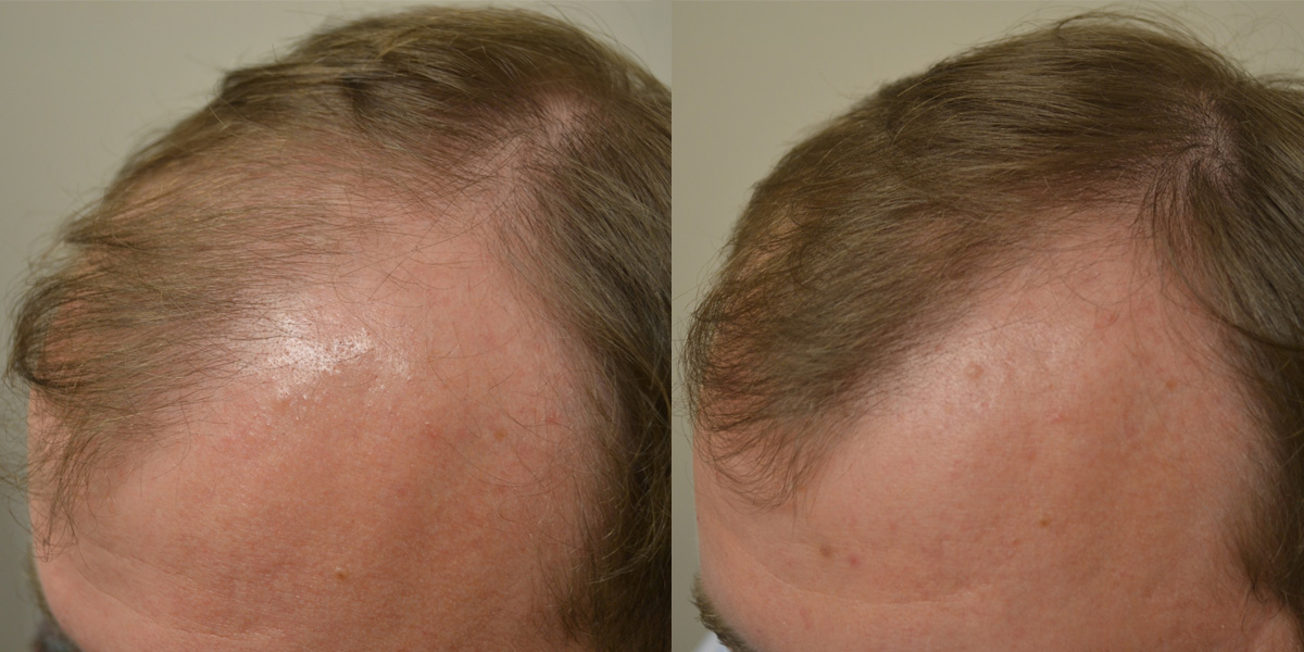 finasteride before and after crown