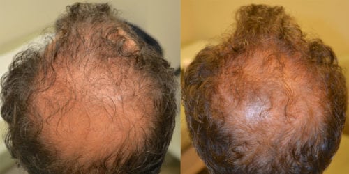 Before and 14 months after initiating treatment with Propecia.
