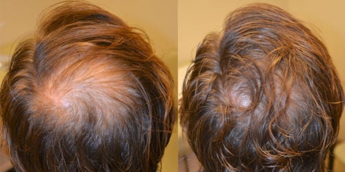 Before and 12 months after initiating treatment with Propecia.