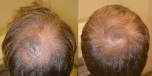 Before and 6 months after initiating treatment with Propecia.