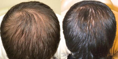 Before and 18 months after initiating treatment with Propecia.