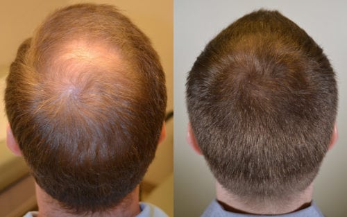 results Archives - Hair Restoration of the South results Archives - Hair Restoration of the South