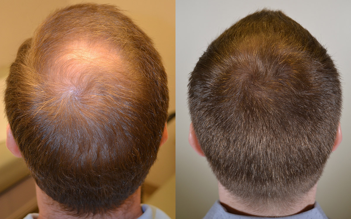 how to take propecia for hair loss
