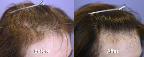 Finasteride 5mg daily and oral minoxidil 1.25mg daily.