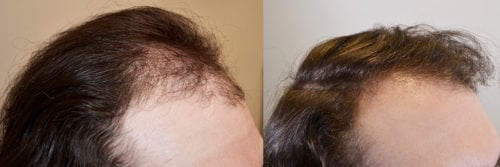 24 year old male, before and 1 year after 1515 hair grafts. Right part.