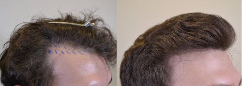 Before and after 1550 hair grafts and full course of medical therapy - after photos is at 1 year post-op.
