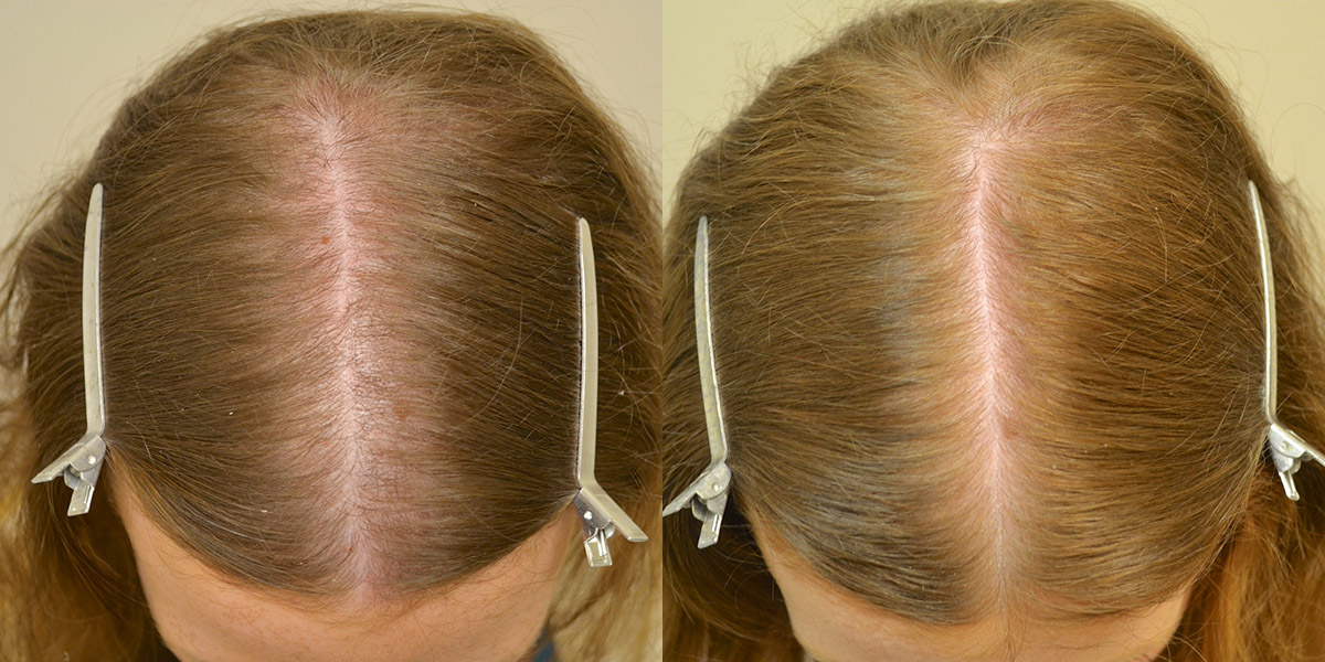 Spironolactone Hair Loss Before And After