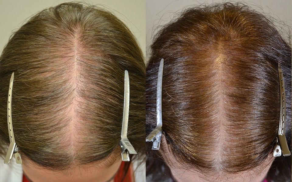 Spironolactone - Hair Restoration of the South - New Orleans, LA