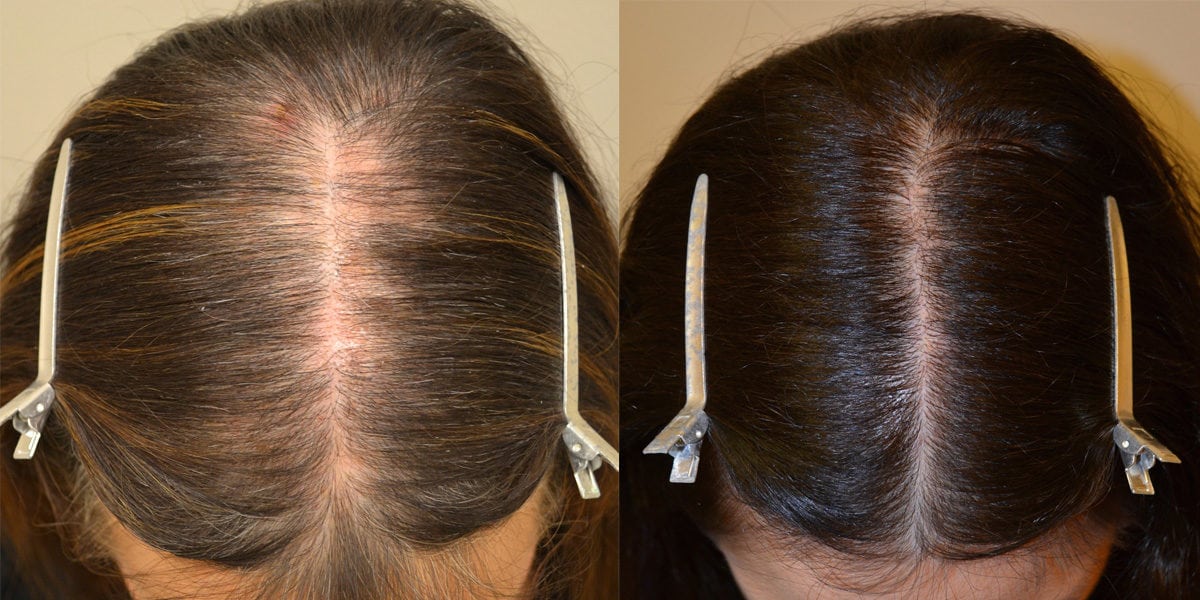 Spironolactone For Females Only Before After Photos Hair 