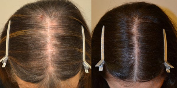 Spironolactone (For Females only) Before & After Photos - Hair ...