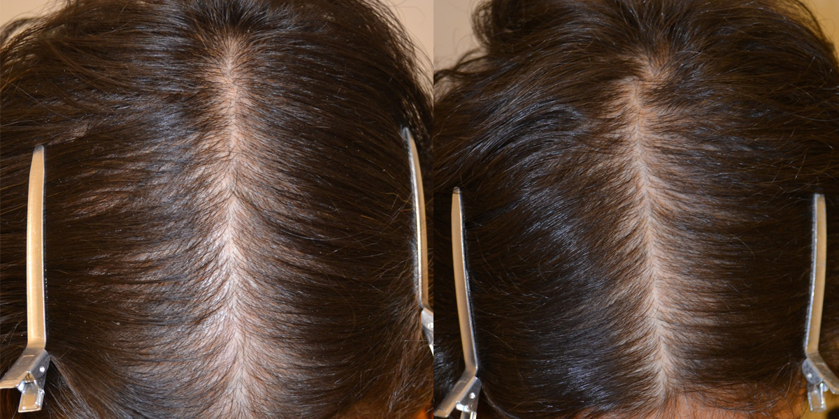 Spironolactone (For Females only) Before & After Photos Hair Restoration of the South New