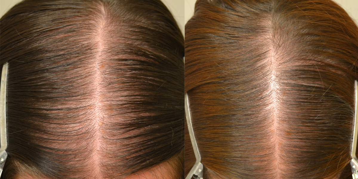 Spironolactone For Females Only Before And After Photos Hair