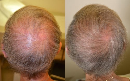 78 y/o female who has successfully regrown the vertex using
oral spironolactone 100mg daily, finasteride 5mg daily. She was allergic to topical minoxidil. After photo 2 years after initiation of therapy.