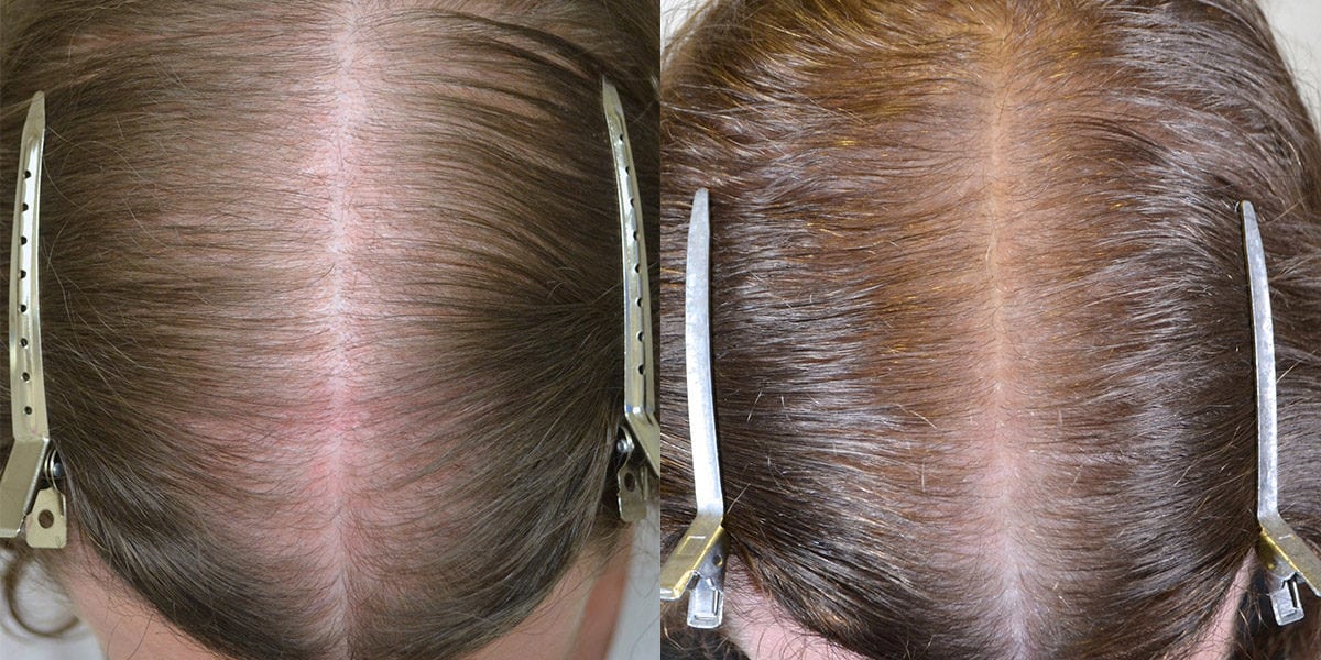 finasteride vs spironolactone for female hair loss reddit