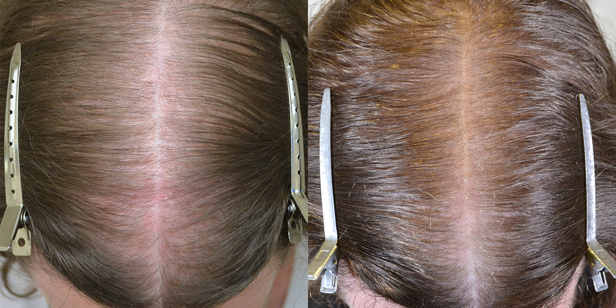 Spironolactone For Females Only Before After Photos Hair