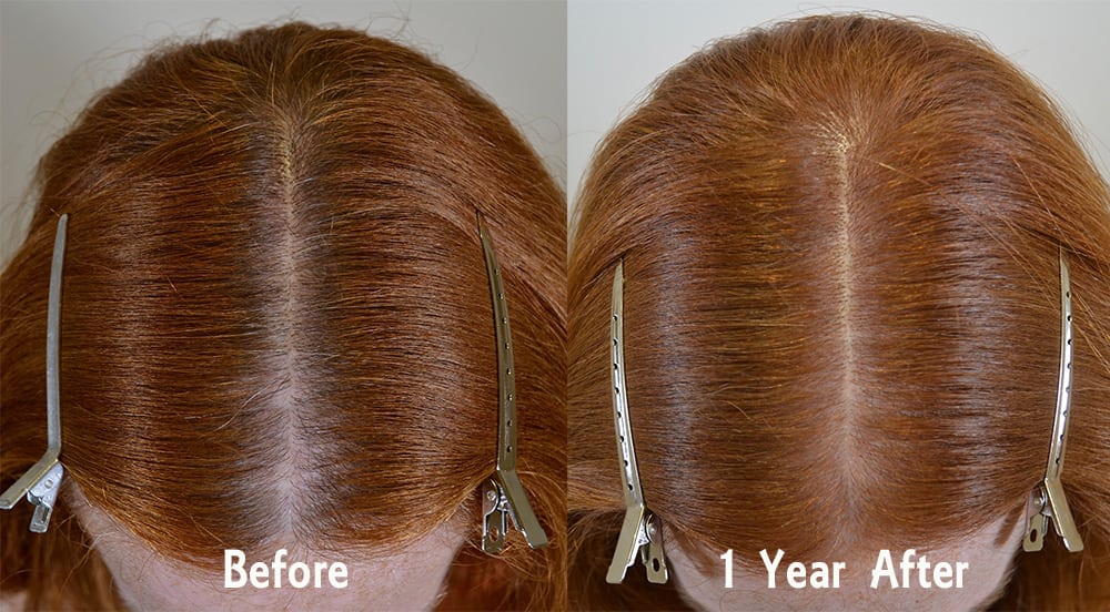 treatment Archives - Hair Restoration of the South