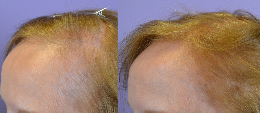 Hair Fibers Transform Hair Loss - Hair Restoration of the South