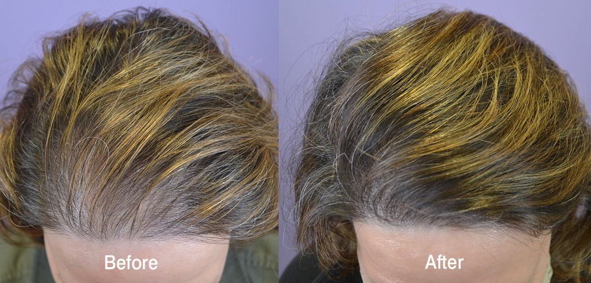 Hair Transplant Before and After Photos: Women - Hair Restoration of the  South - New Orleans, LA