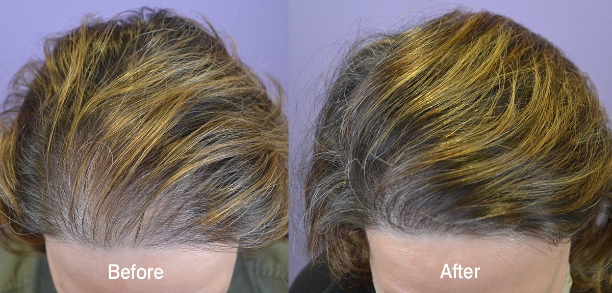 Hair Transplant Before and After Photos: Women - Hair Restoration of the South - New Orleans, LA Hair Transplant Before and After Photos: Women - Hair Restoration of the South - New Orleans, LA