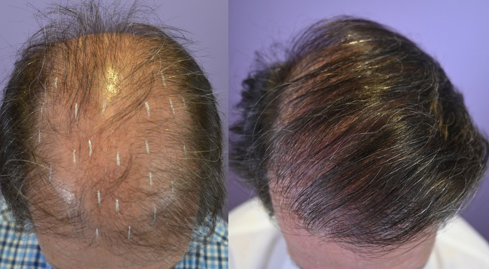 Hair Transplant on 64 Year Old Male with Diffuse Hair Loss - Hair  Restoration of the South