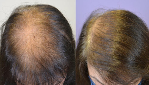 Top view before and after medical therapy and FUT hair transplant.