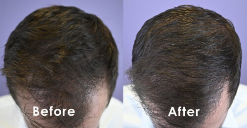 Top view before and one year post FUE hair transplant.