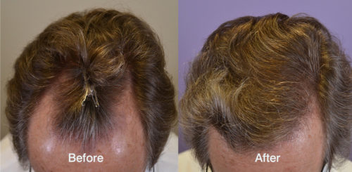 Hairline restoration, 1100 grafts harvested via FUT.