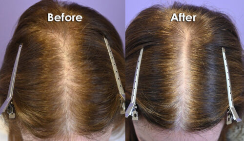 Finasteride 5mg daily and oral minoxidil 1.25mg daily.