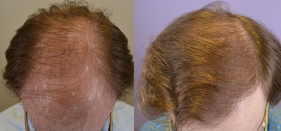 One Year Hair Transplant Follow Up - Hair Restoration of the South