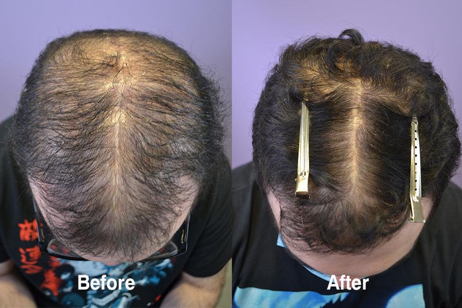 Medical Hair Loss Therapy For 22 Year Old Male With Significant Thinning - Hair Restoration of the South Medical Hair Loss Therapy For 22 Year Old Male With Significant Thinning - Hair Restoration of the South