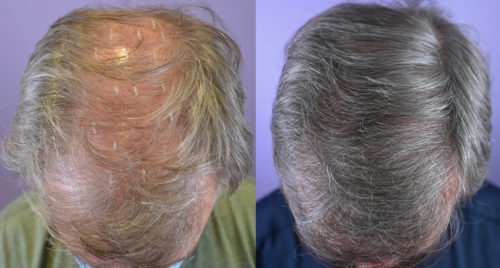 Before and 1 year after  FUR hair transplant - Top view.