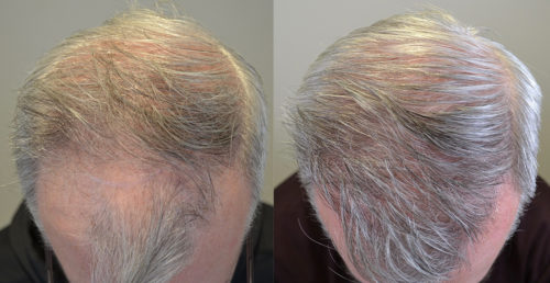 42 YO - 12 FUE Grafts