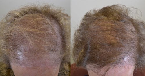 Hair Transplant to Conceal Browlift - 72 year old female
