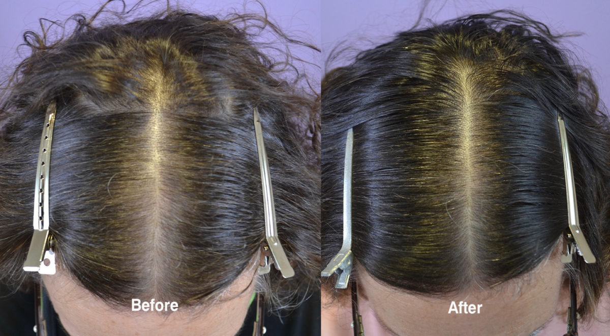 Finasteride 5mg daily and oral minoxidil 1/2 of 2.5mg daily for Female