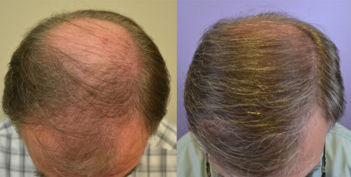 70 year old male - Norwood Hair Loss Classification 5/6 - 2 Sessions - Total of 2,943 total grafts harvested via FUT.