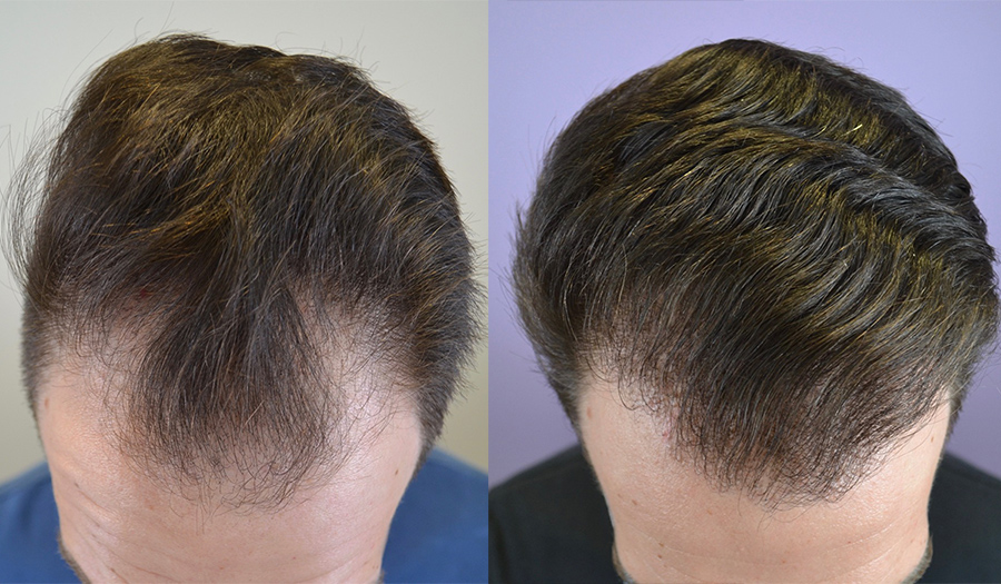 Hairline Restoration of 30 Year Old Male, Norwood Class III - Hair  Restoration of the South