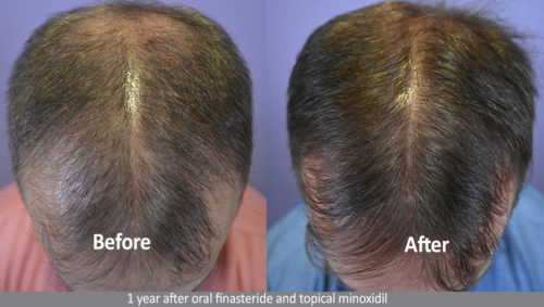 1 year after oral finasteride and topical minoxidil