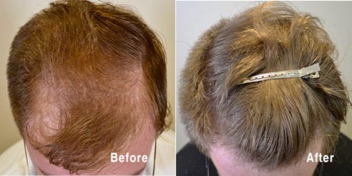 hair loss treatment Archives - Hair Restoration of the South