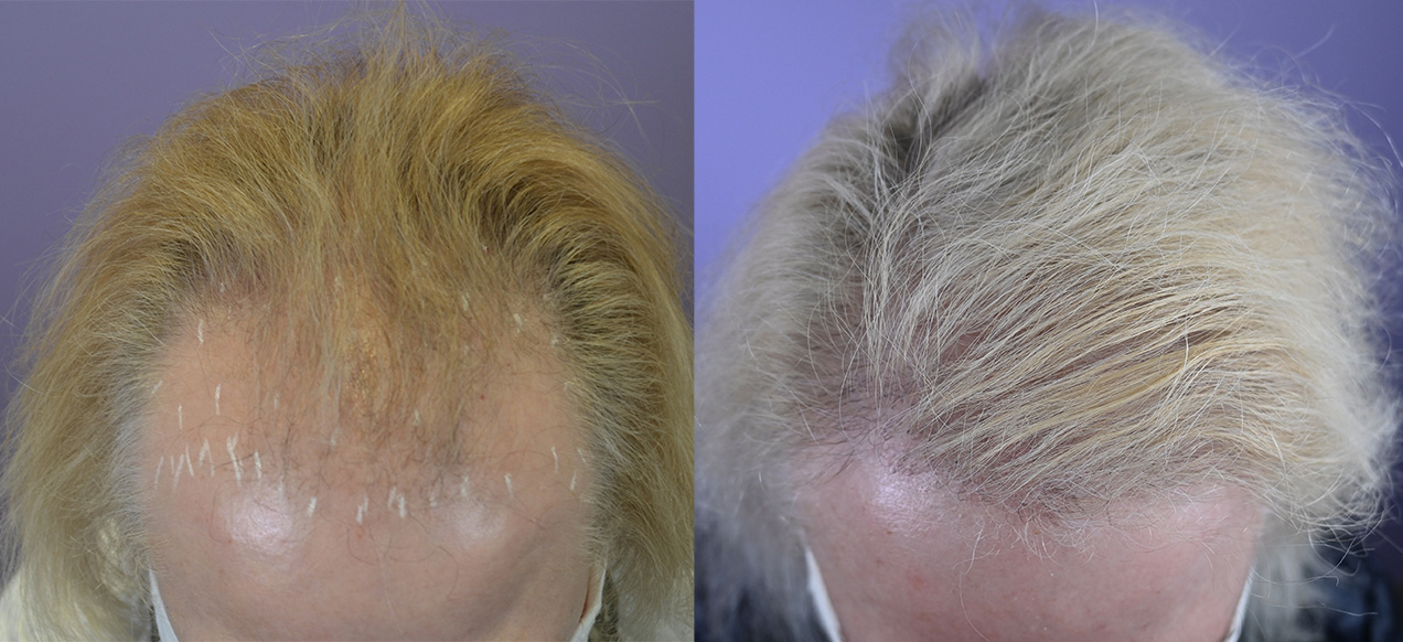 Female Hairline Restoration - Hair Restoration of the South