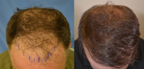48 year old male, Norwood Class V hair loss. After - one session 1500 grafts year post op.